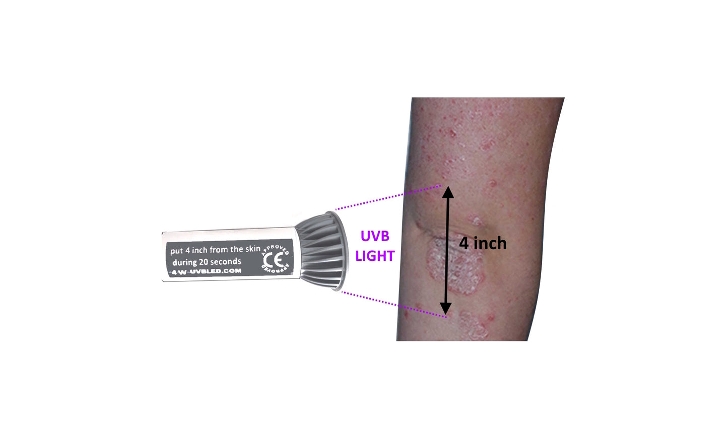 Medizinische Lampe für Psoriasis, Vitiligo und Ekzem