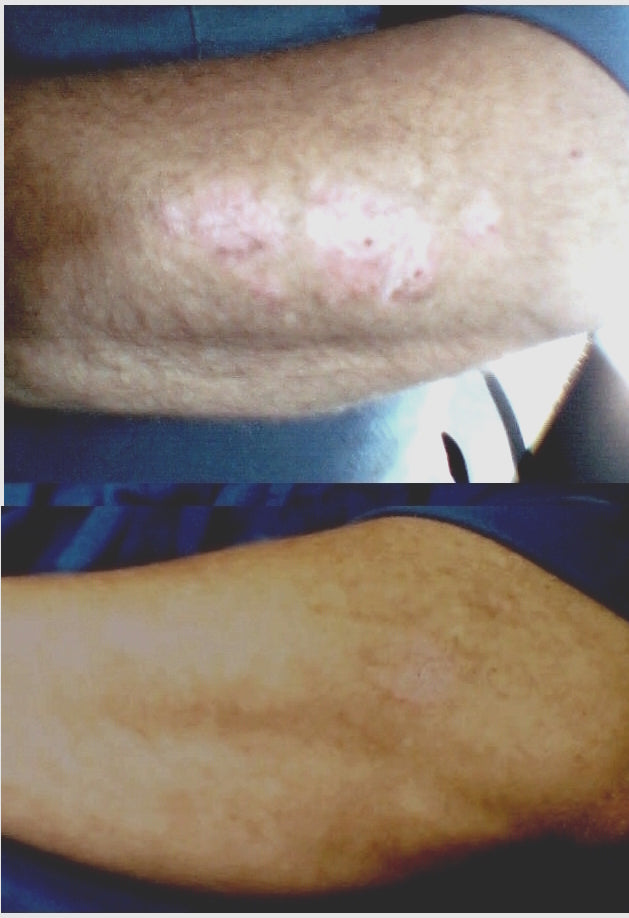 Psoriasis-Ekzem-Vitiligo-Behandlungslampe